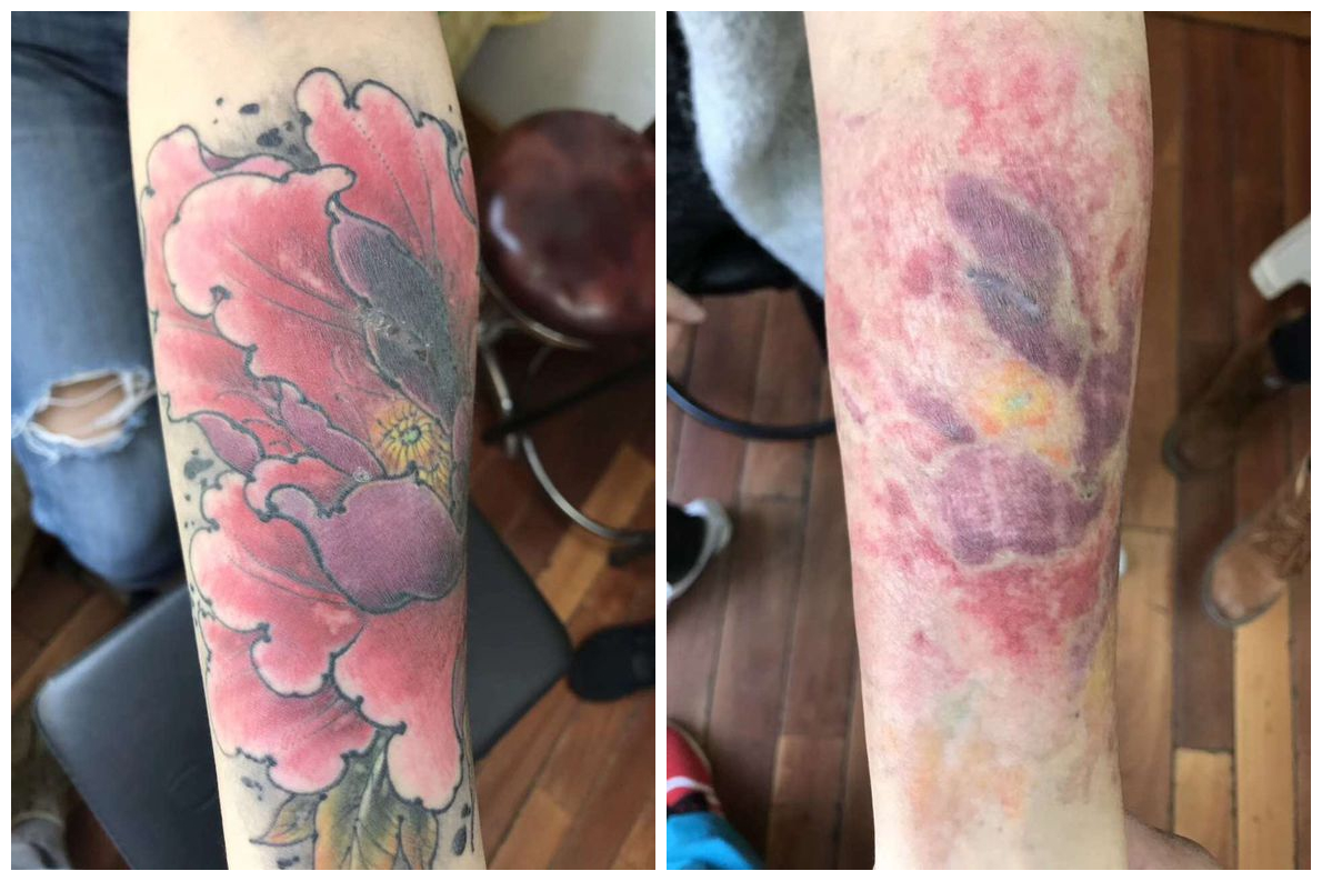 铁木针专业清洗纹身武汉专业洗纹身店祛纹身不留疤
