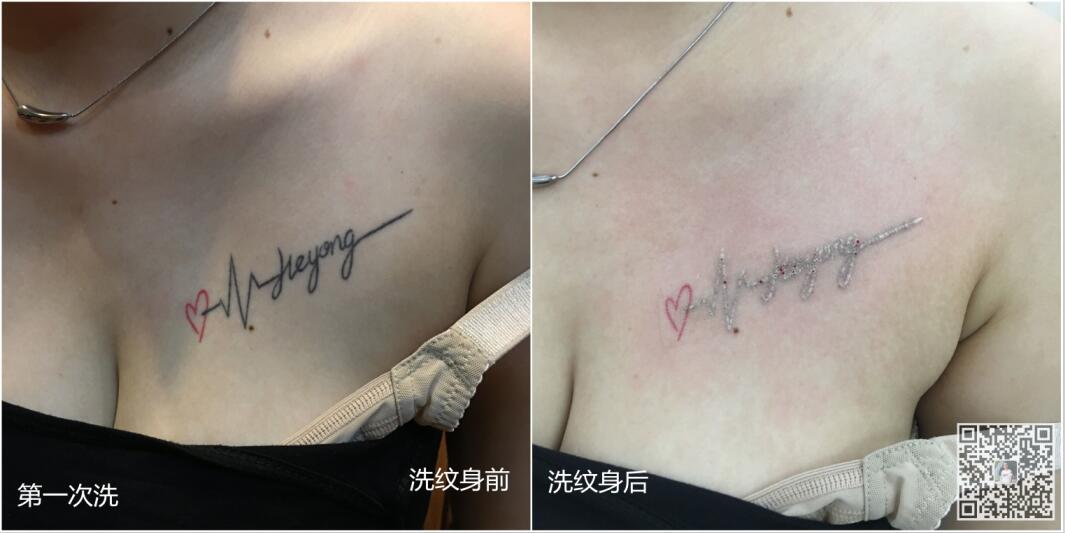 洗纹身武汉洗纹身皮秒洗纹身去除纹身图案湖北专业洗纹身铁木针刺青武汉洗纹身1哪里好 (5).jpg